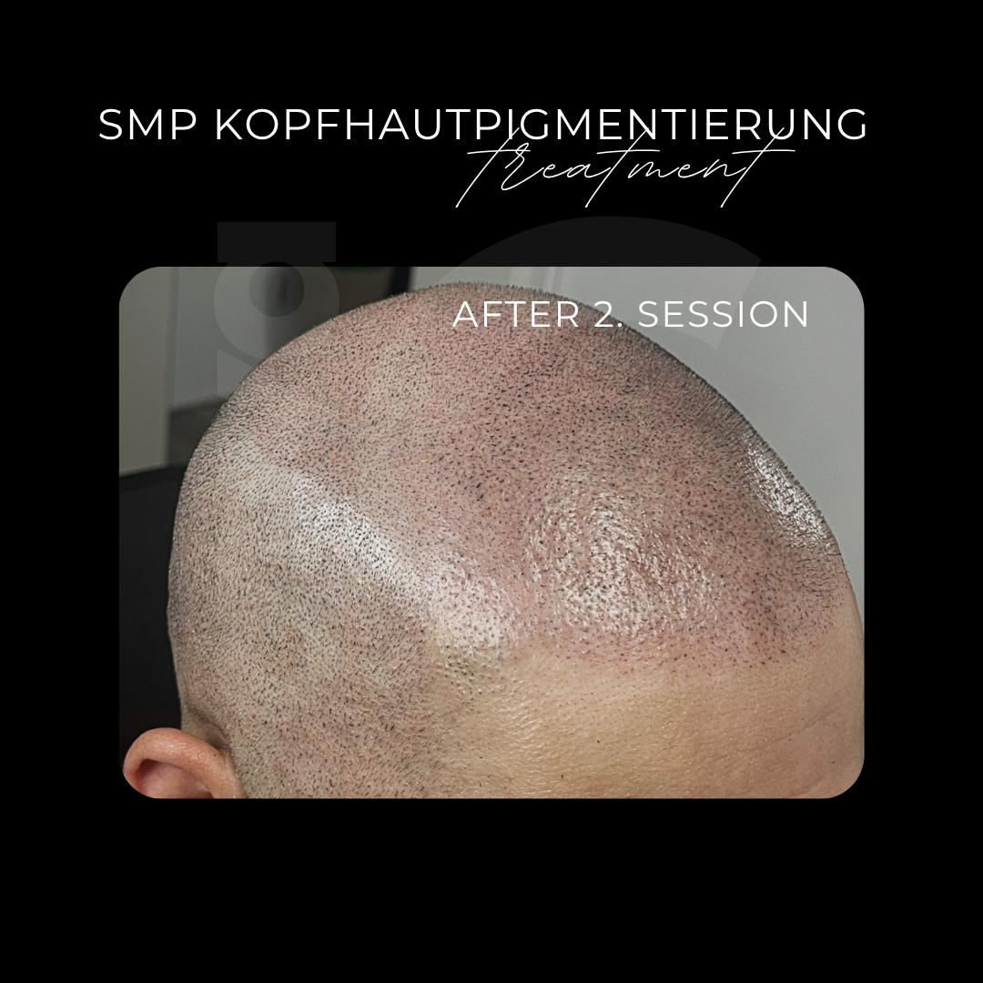 Scalp Micropigmentation – Ablauf, Kosten & Ergebnisse 