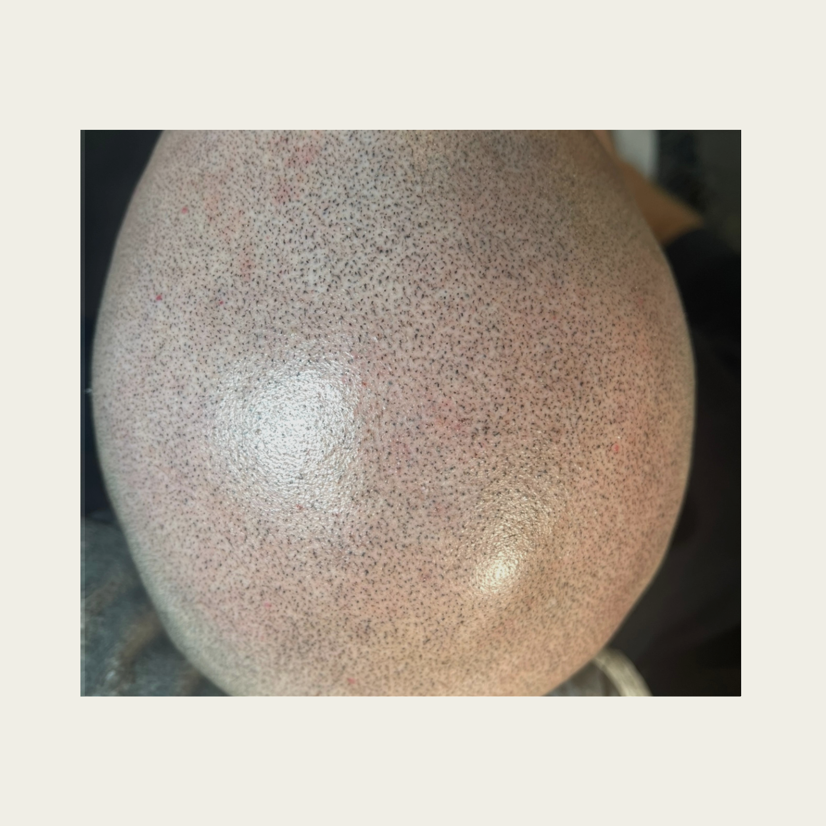 Scalp Micropigmentation – Ablauf, Kosten & Ergebnisse 