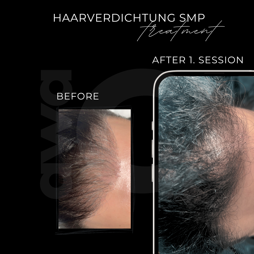 Haarverdichtung in Grevenbroich