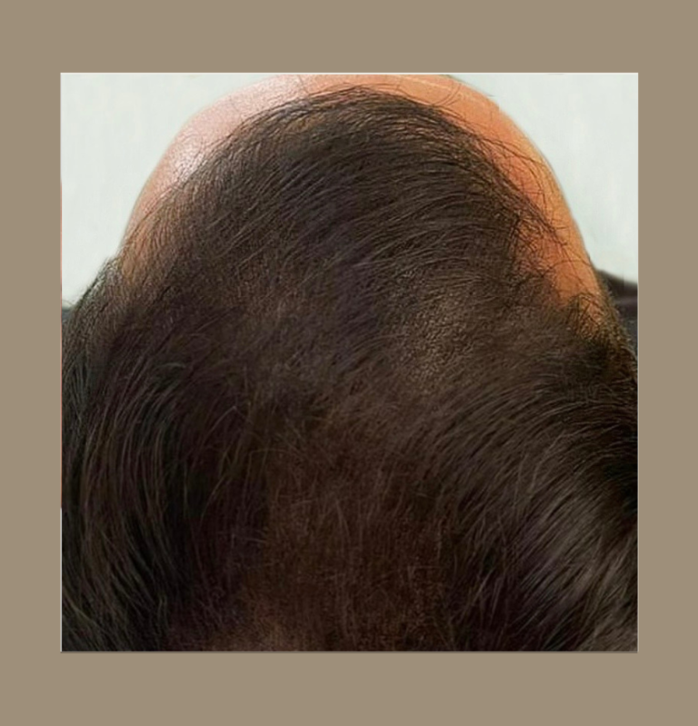 Haarverdichtung SMP bei lichtem schütteren Haar Geheimratsecken bei awacosmetics