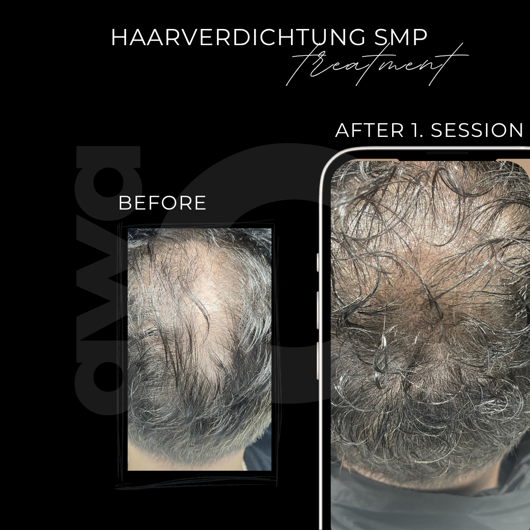 Haarverdichtung in Grevenbroich