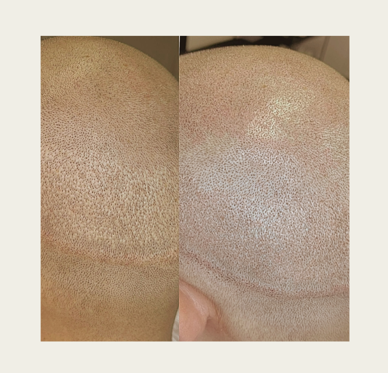 Haarpigmentierung Kopfhautpigmentierung 4D bei Glatze oder lichtem Haar in Grevenbroich