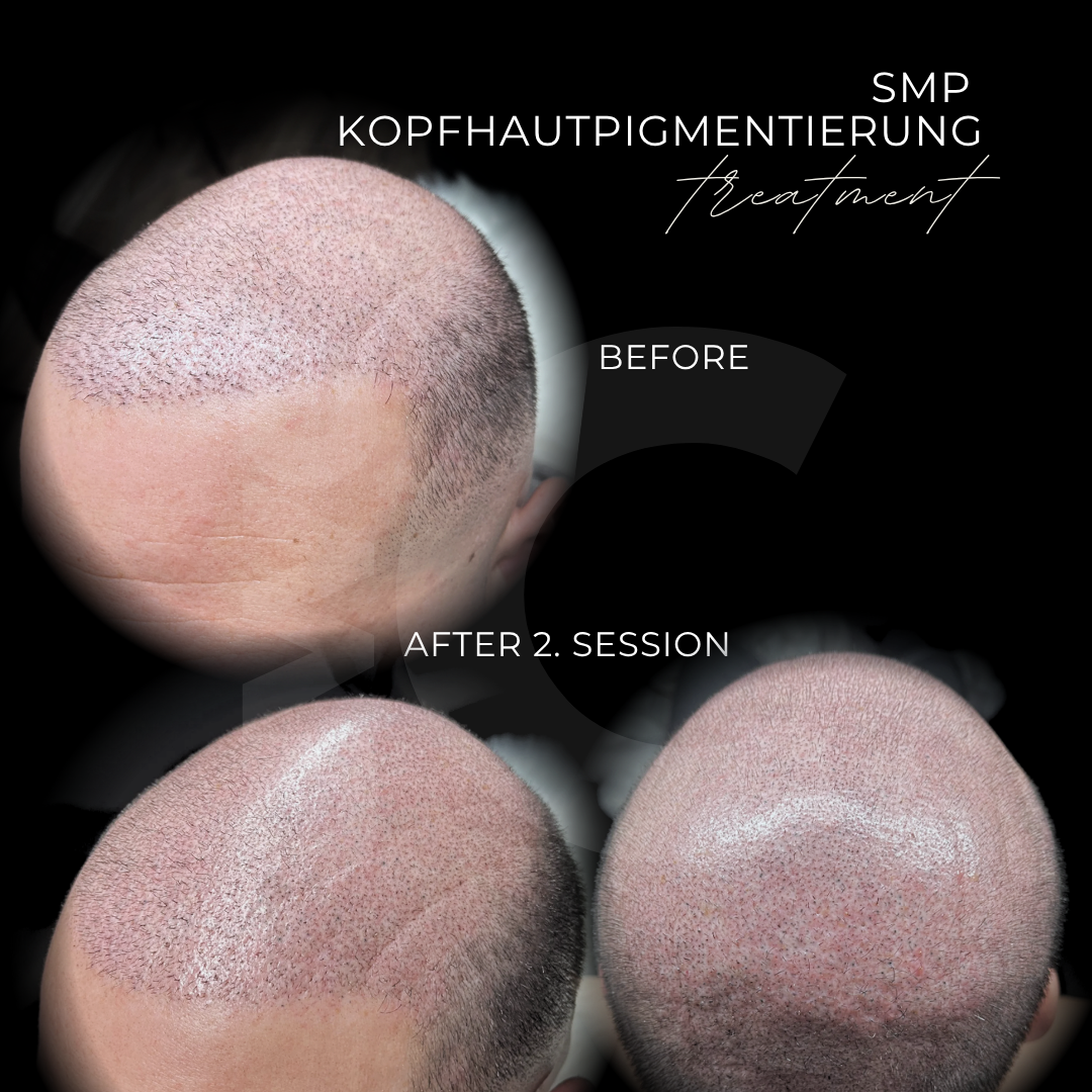 Scalp Micropigmentation in Grevenbroich