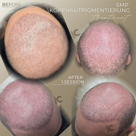 Scalp Micropigmentation Vorher Nachher 1. Sitzung