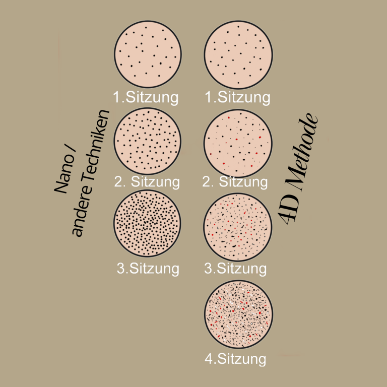 3 Sitzungen normale Pigmentierung, 4 Sitzungen 4D-Methode