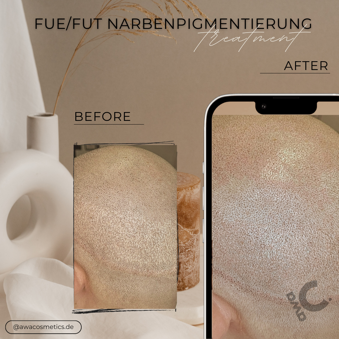 Narbenpigmentierung Micropigmentation SMP in Grevenbroich