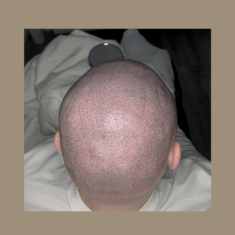 Haarpigmentierung Kopfhautpigmentierung 4D bei Glatze oder lichtem Haar in Grevenbroich