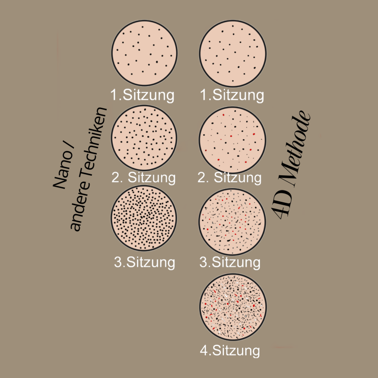3 Sitzungen normale Pigmentierung, 4 Sitzungen 4D-Methode
