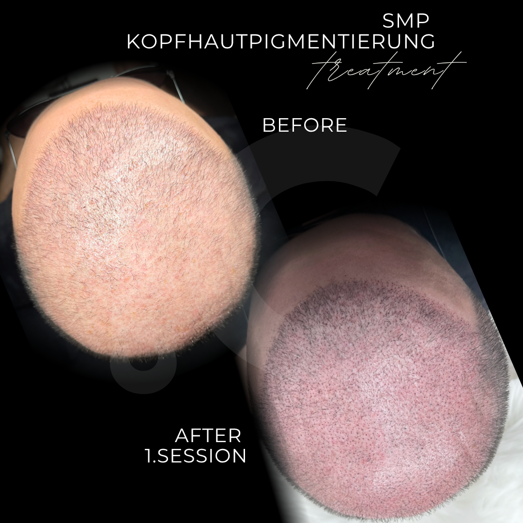 Haarpigmentierung 4D nach Haartransplantation