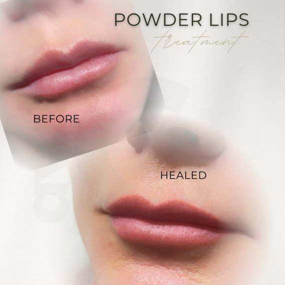 Abgeheilte Lippenpigmentierung