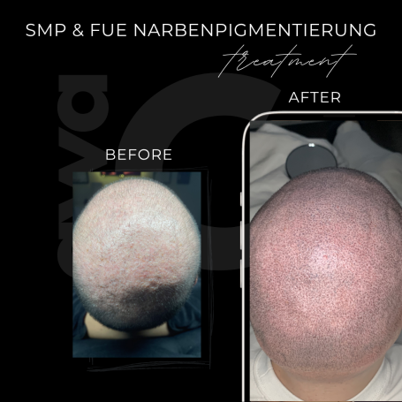SMP und FUE Vorher Nachher in Grevenbroich