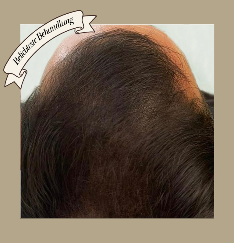 Haarverdichtung SMP bei lichtem schütteren Haar Geheimratsecken bei awacosmetics