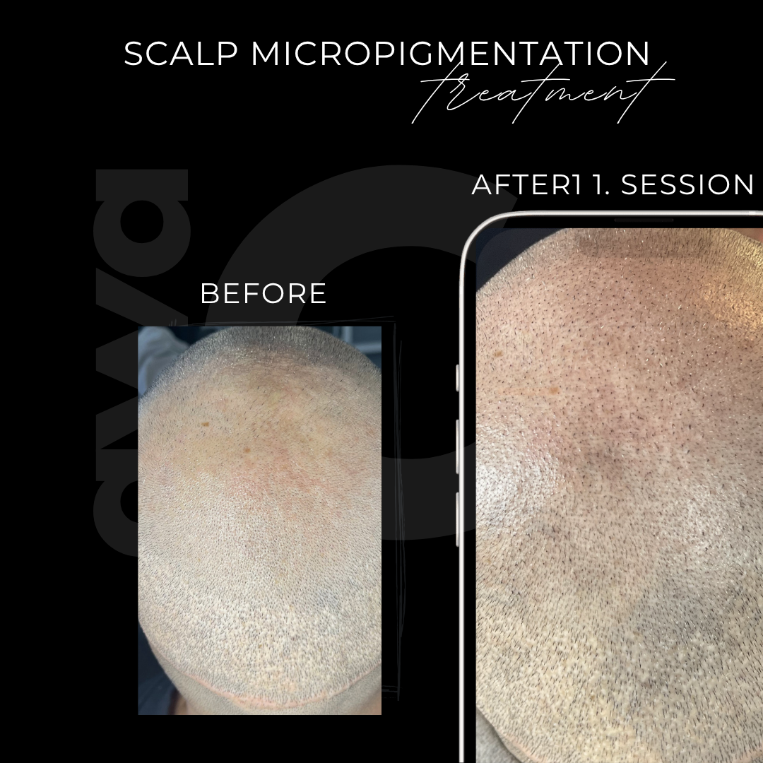 Vorher Nachher Scalp Micropigmentation SMP