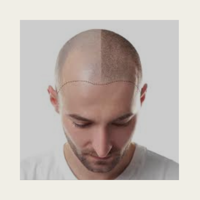 Haarpigmentierung Kopfhautpigmentierung 4D bei Glatze oder lichtem Haar in Grevenbroich