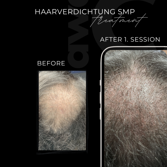 Vorher Nachher SMP Haarverdichtung