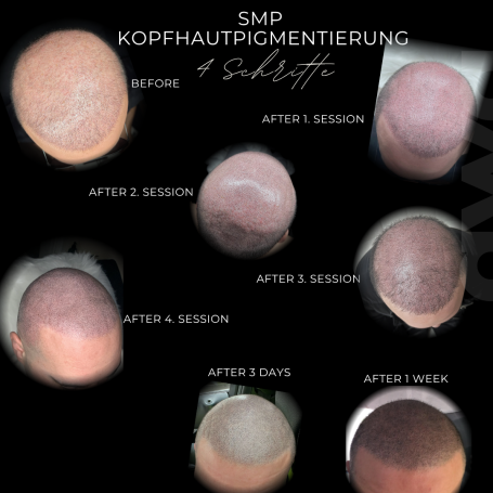 4 Schritte bis zum kompletten Ergebnis Scalp Micropigmentation