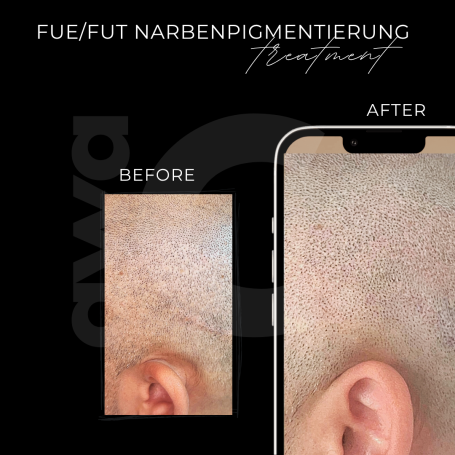FUE Narbenpigmentierung Grevenbroich Vorher Nachher