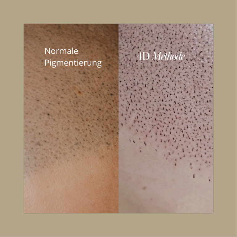 Normale Scalp Pigmentierung vs 4D Methode