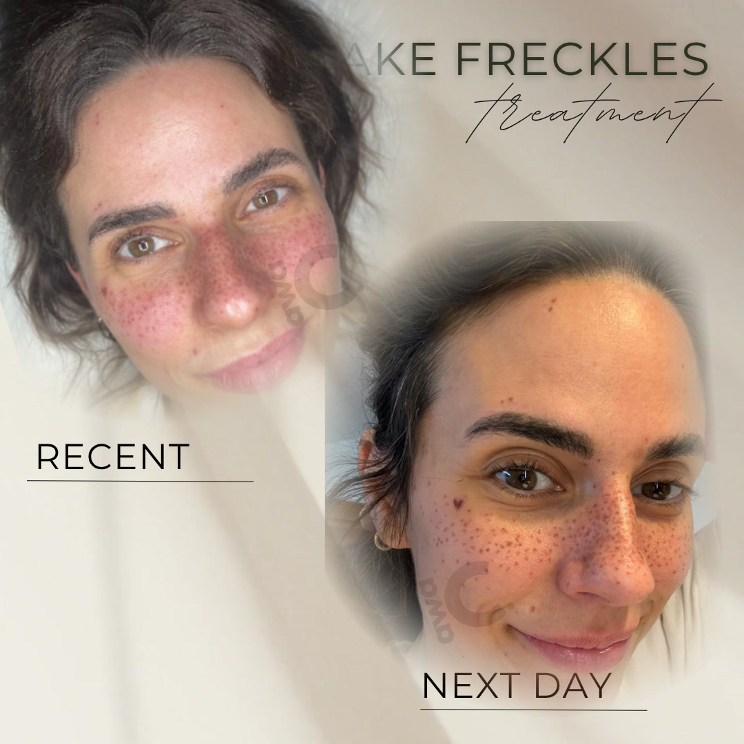 Sommersprossen PMU in Grevenbroich