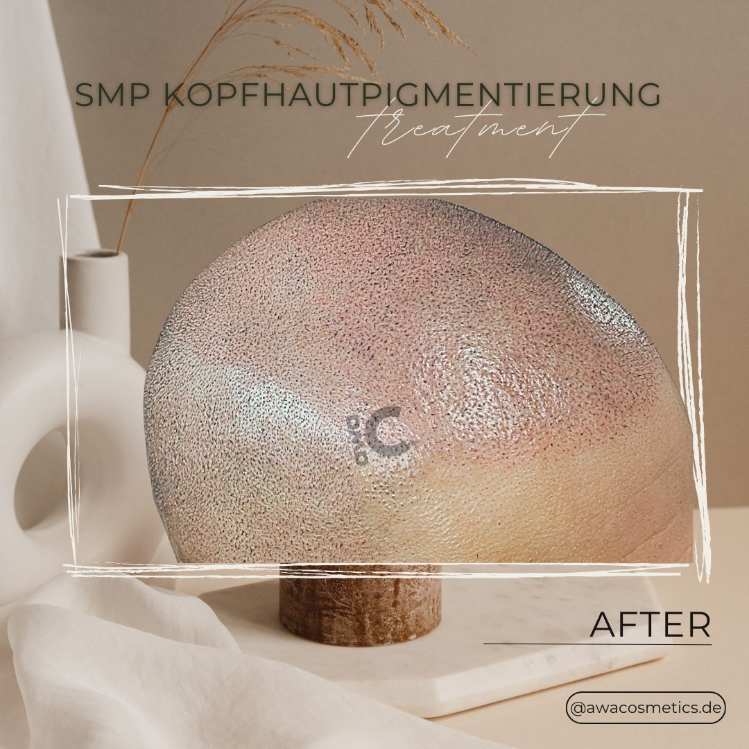 Nachher Scalp Micropigmentation